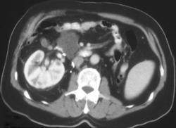 Cystadenoma of the Pancreas - CTisus CT Scan