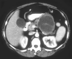 Cystadenoma of the Pancreas - CTisus CT Scan