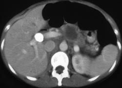 Pancreatic Adenocarcinoma - CTisus CT Scan