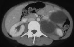 Cystadenoma Pancreas Extends Into the (lt) Psoas Muscle - CTisus CT Scan