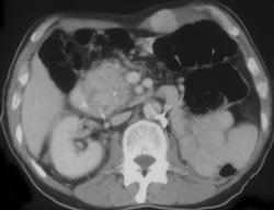 Metastatic Renal Cell Carcinoma to the Pancreas and Abdominal Wall - CTisus CT Scan