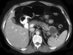 Cystic Tumor of the Tail of the Pancreas - CTisus CT Scan