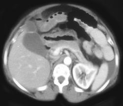 Pancreatic Abscess - CTisus CT Scan