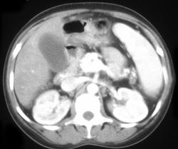 Chronic Pancreatitis - CTisus CT Scan