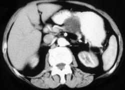 Cystadenoma of the Pancreas - CTisus CT Scan