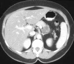 Cystadenoma of the Pancreas - CTisus CT Scan