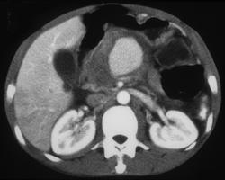 Pseudoaneurysm of the Gastric Artery - CTisus CT Scan