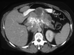 Calcified Notes Simulate A Pancreatic Mass (ovarian Cancer) - CTisus CT Scan