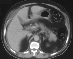 Islet Cell Tumor of the Pancreas (tail) - CTisus CT Scan