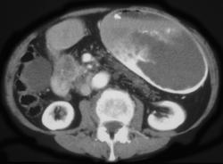 Pancreatic Cancer Results in A Gastric Outlet Obstruction - CTisus CT Scan