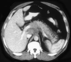 Lymphoma Infiltrating the Pancreas - CTisus CT Scan