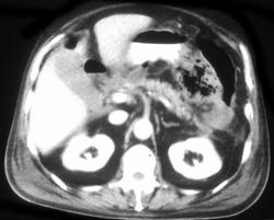 Pancreatic Abscess - CTisus CT Scan