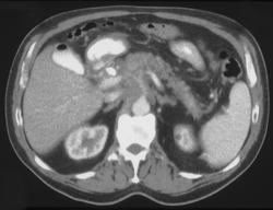 Carcinoma of the Pancreas Encases the SMA - CTisus CT Scan