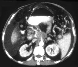 Invasive Recurrent Cancer of the Pancreas - CTisus CT Scan