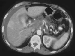 Infiltrating Adenocarcinoma of the Pancreas - CTisus CT Scan