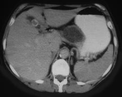 Neurofibroma of the Pancreas - CTisus CT Scan