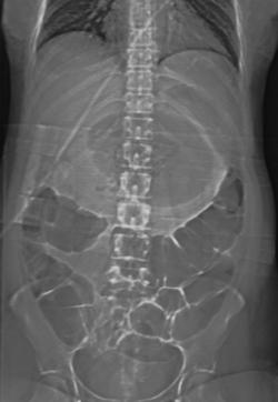 Pancreatic Abscess - CTisus CT Scan