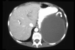 Splenic Compression By A Pancreatic Pseudocyst - CTisus CT Scan