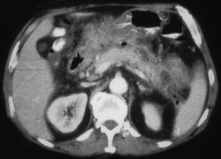 Early Pancreatic Abscess - CTisus CT Scan