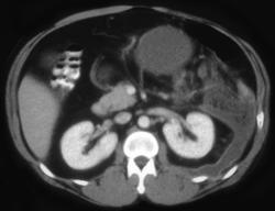 Acute Pancreatitis With Fluid in (lt) Pararenal Space - CTisus CT Scan