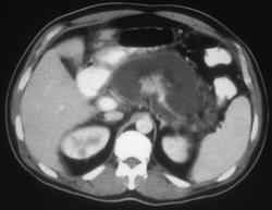 Acute Pancreatitis - CTisus CT Scan