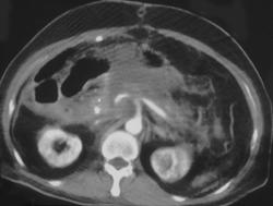 Severe Pancreatitis - CTisus CT Scan