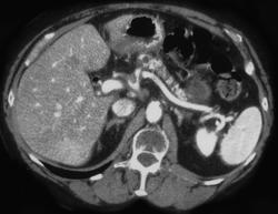 Normal Post Whipple - CTisus CT Scan