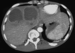 Necrotic Liver Metastases - CTisus CT Scan