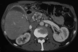 Portal Vein Thrombosis Secondary to Chronic Pancreatitis- Cavernous Transformation of the Portal Vein (CTPV) Also Seen - CTisus CT Scan