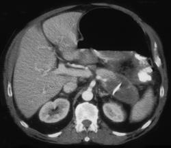 Pancreatic Abscess With Drain - CTisus CT Scan