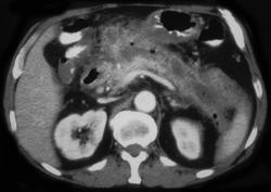 Pancreatic Abscess - CTisus CT Scan