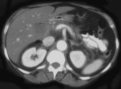 Chronic Pancreatitis - CTisus CT Scan