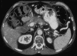 Recurrent Pancreatic Cancer - CTisus CT Scan