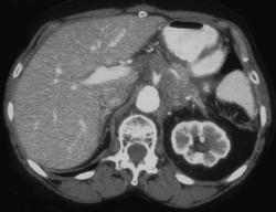 Islet Cell Carcinoma of the Pancreas With Vessel Encasement - CTisus CT Scan