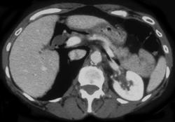 Post ERCP-chronic Pancreatitis - CTisus CT Scan