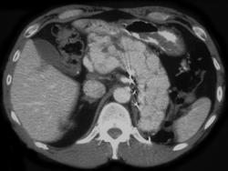 Metastases to the Pancreas From Renal Cell Carcinoma. Muscle Metastases Also Present (paraspinal) - CTisus CT Scan