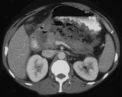 Pancreatic Abscess - CTisus CT Scan