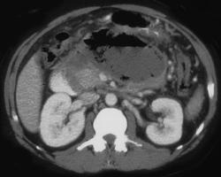 Pancreatic Abscess - CTisus CT Scan