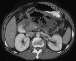 Pancreatic Abscess - CTisus CT Scan