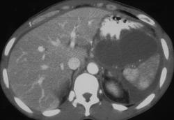 Pseudocyst Compresses the Spleen - CTisus CT Scan