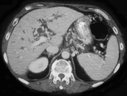 Carcinoma of the Pancreas With Vessel Encasement - CTisus CT Scan