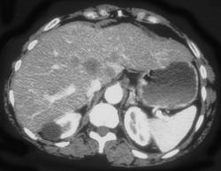 Carcinoma of the Pancreas With Liver Metastases - CTisus CT Scan