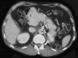 Metastatic Renal Cell Carcinoma to the Pancreas - CTisus CT Scan