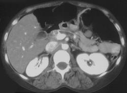 Chronic Pancreatitis - CTisus CT Scan