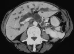 Dilated Common Bile Duct (CBD) & Intrahepatic Ducts Due to Carcinoma of the Head of the Pancreas - CTisus CT Scan