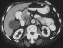 Pancreatic Cancer - CTisus CT Scan