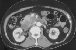 Pancreatic Cancer - CTisus CT Scan