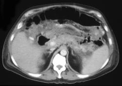 Pancreatic Abscess - CTisus CT Scan