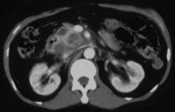 Pancreatic Cancer-(unusually Cystic) - CTisus CT Scan