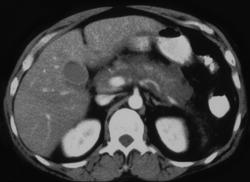 Acute Pancreatitis - CTisus CT Scan